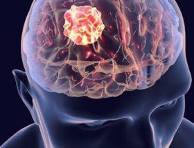 Jak dostarczyć lek bezpośrednio do nowotworu mózgu? Badacze pokonali barierę krew-mózg