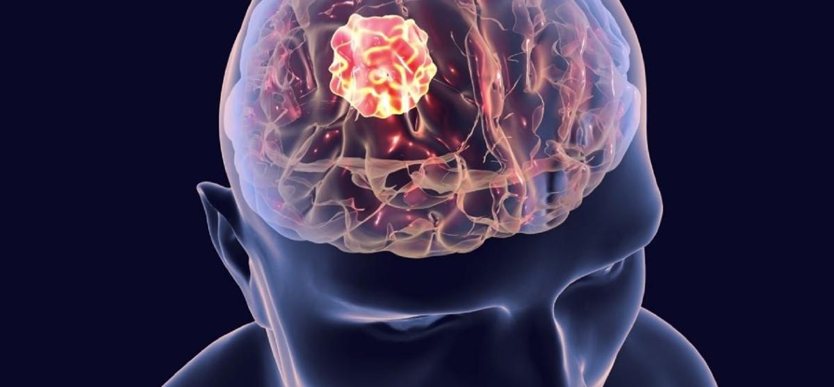 Jak dostarczyć lek bezpośrednio do nowotworu mózgu? Badacze pokonali barierę krew-mózg