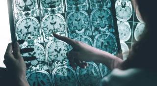 Naukowcy sfabrykowali wyniki badań nad chorobą Alzheimera