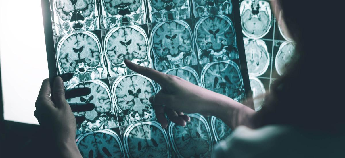 Naukowcy sfabrykowali wyniki badań nad chorobą Alzheimera